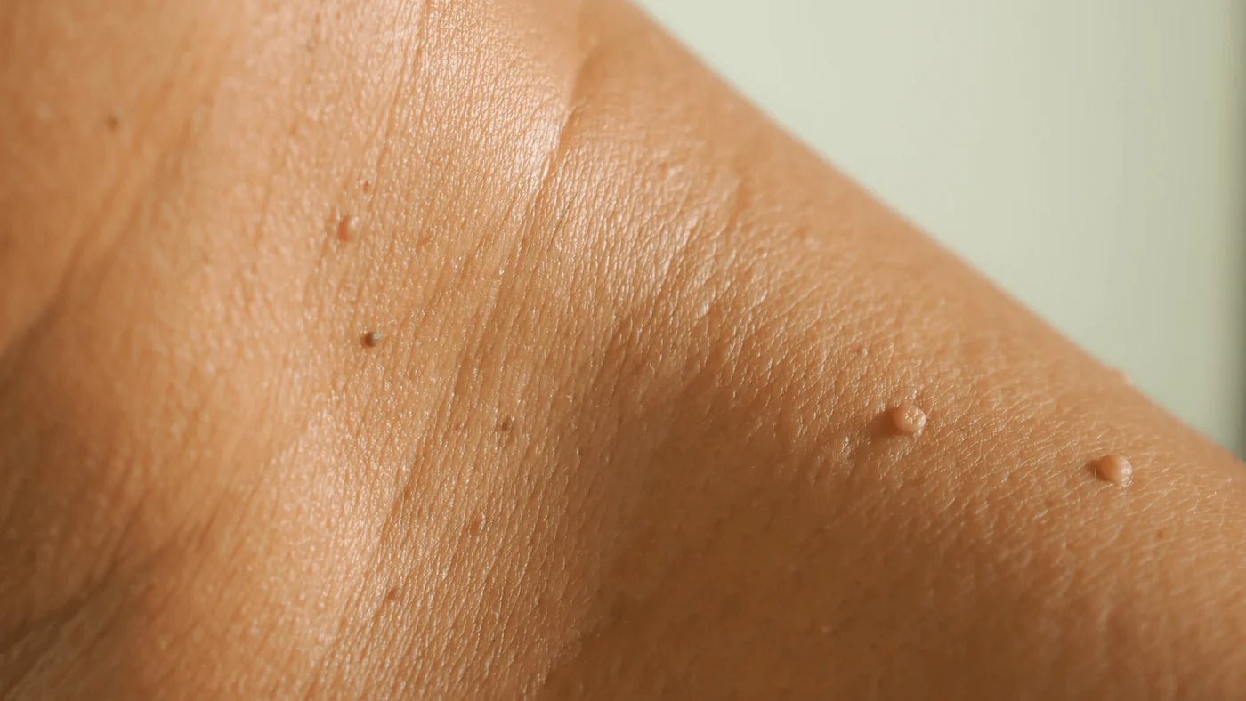 The Link Between Skin Tags and Insulin Resistance - Nature Provides